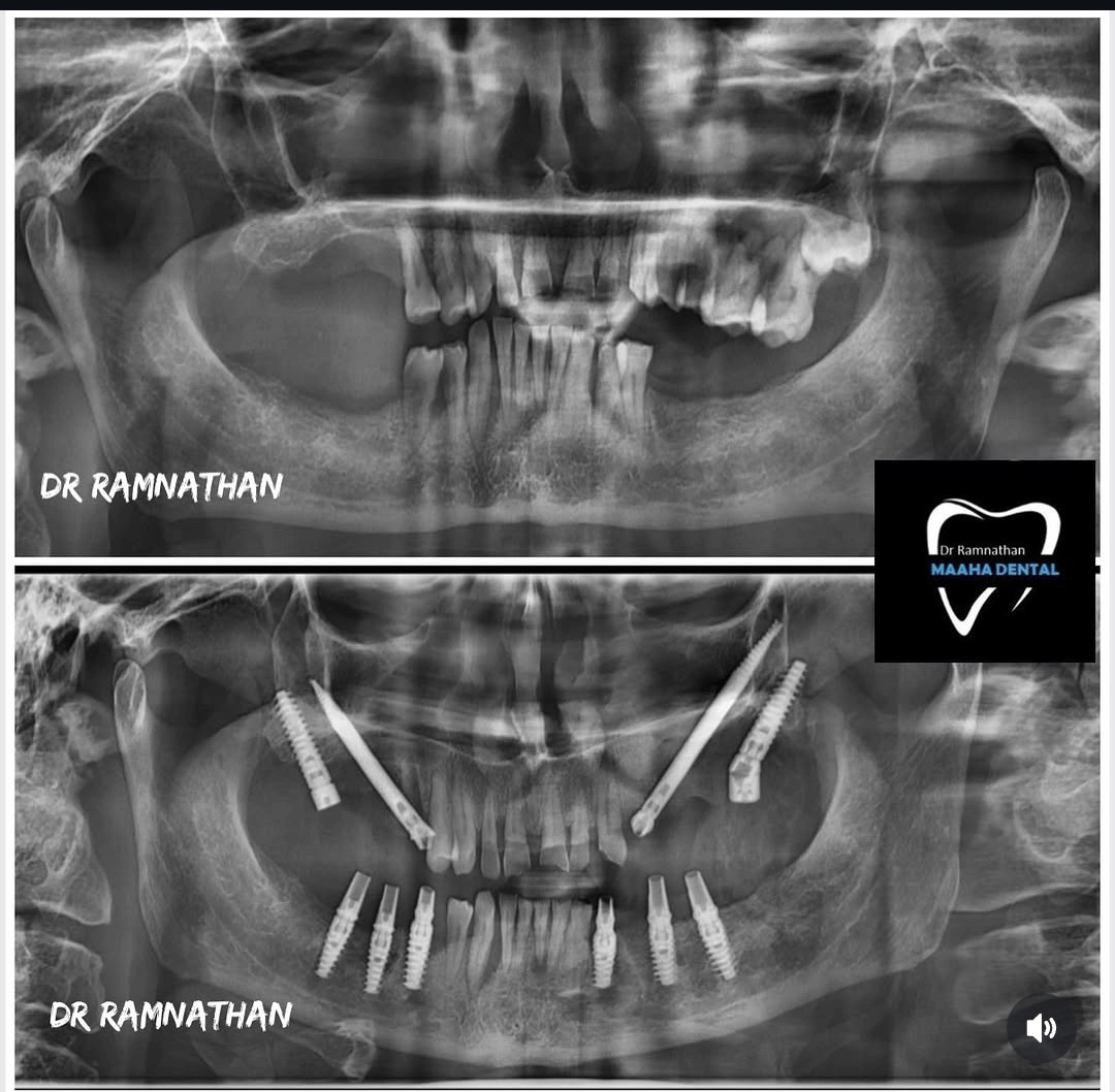 Full Mouth Implantation